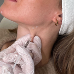Botox halsmuskel platysma